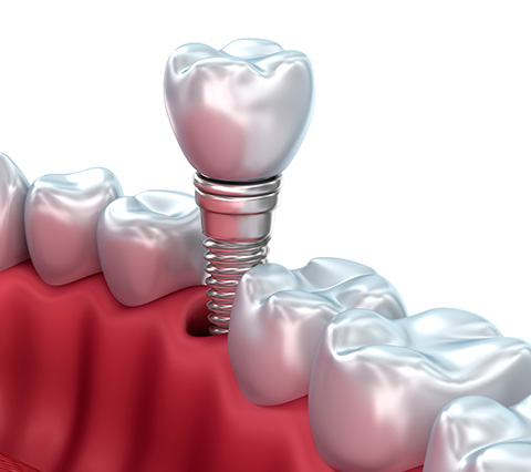 Colocacin de implante durante tratamiento de implantes dentales en Bogot