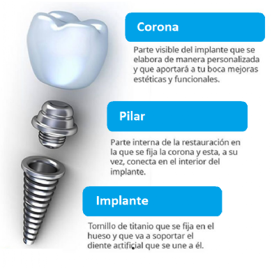 Dental Implan Parts
