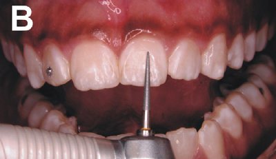proceso microabrasion aclaramiento dental
