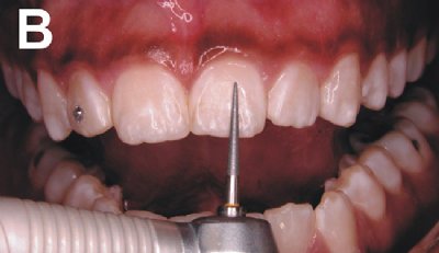proceso microabrasion aclaramiento dental