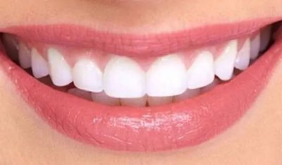 Resultados-de-aclaramiento-dental-con-microabrasion