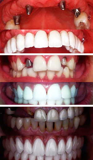 Coronas Libres de Metal - Clínicas White - Restaura tu dentadura