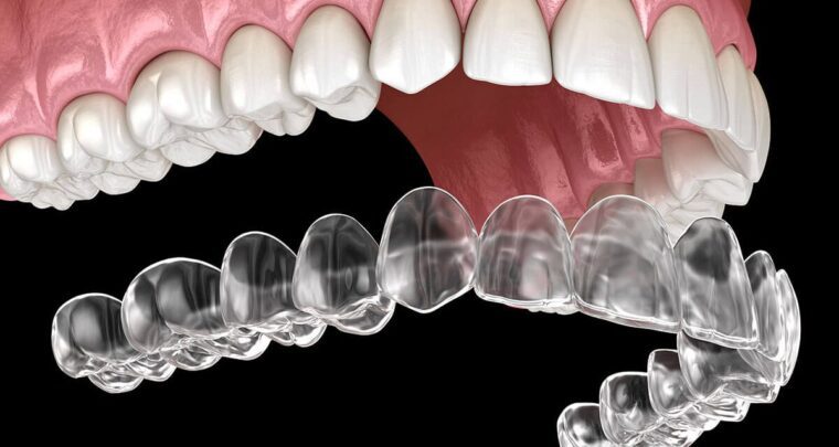Nadie sabrá que usas ortodoncia invisible Paciente de ortodoncia invisible sonriendo