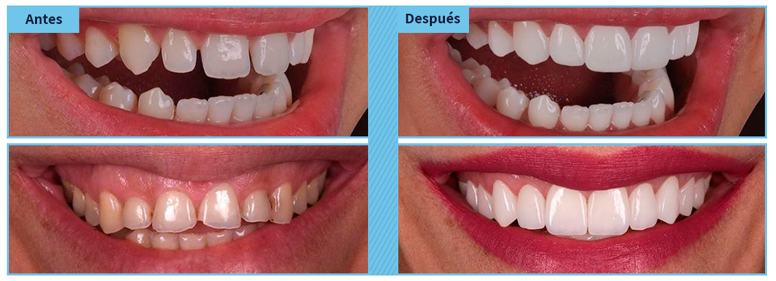 Trabajos de diseo de sonrisa en Bogot realizados por Clnicas White