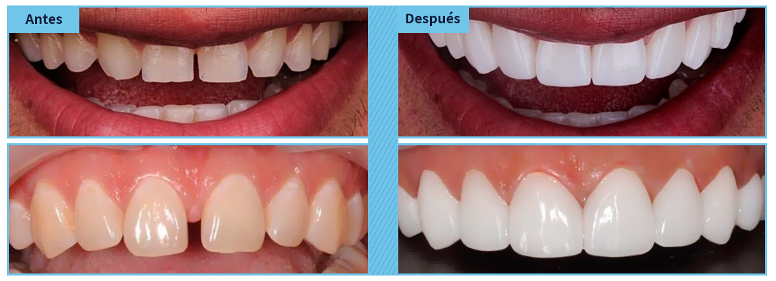 Tratamientos de diseo de sonrisa en Bogot