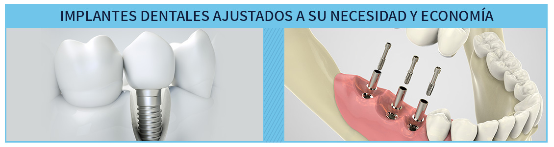 Colocación de implantes dentales en Bogotá