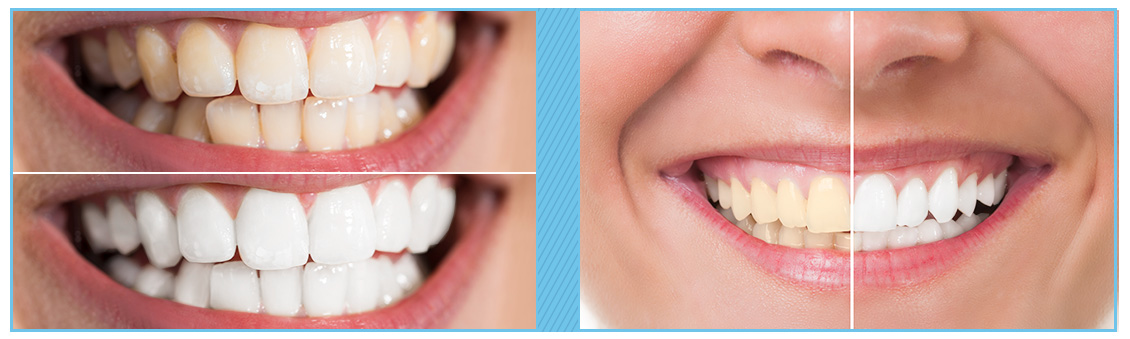 Con nosotros tendrás un efectivo blanqueamiento dental en Bogotá Personas con blanqueamiento dental en Bogotá
