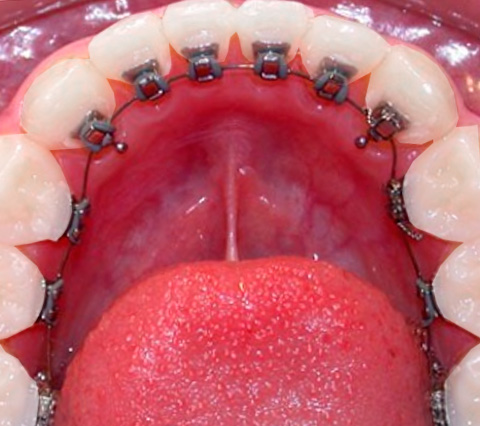 Tratamiento de ortodoncia invisible en Bogotá