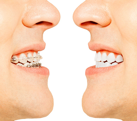 Use brackets temporalmente y tenga el mejor tratamiento de ortodoncia Comparación por tratamiento de ortodoncia en Bogotá
