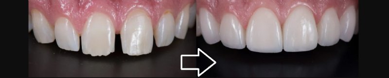 gana confianza con diseo de sonrisa con carillas