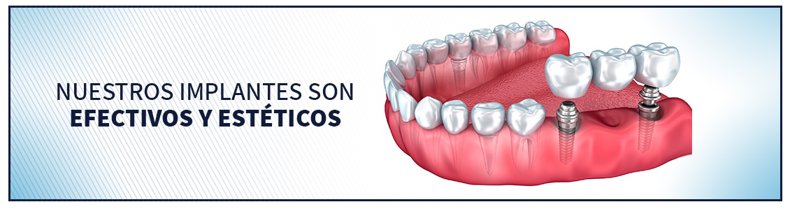 Posición de implantes en estructura dental, implantología en Bogotá