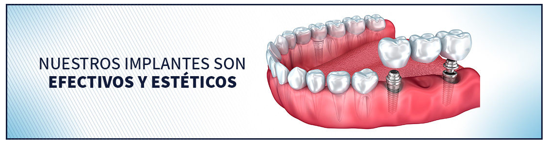 La implantología en Bogotá debe hacerse por expertos Posición de implantes en estructura dental, implantología en Bogotá